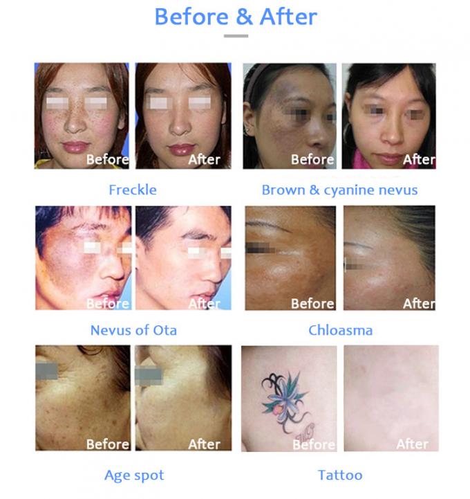 Máquina de la belleza del tratamiento de los problemas de piel del retiro del tatuaje del laser del picosegundo de Honkon con menos Pih 1