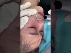 máquina del laser del picosegundo del salón de 1064nm 532nm para el tratamiento del problema de las lesiones de la pigmentación de la piel